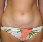 Mini Tummy Tuck