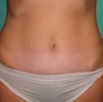 Mini Tummy Tuck