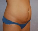 Mini Tummy Tuck