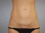 Mini Tummy Tuck