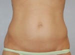 Mini Tummy Tuck