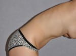 Tummy Tuck