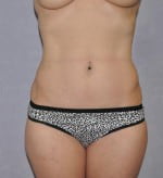 Tummy Tuck