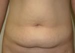 Tummy Tuck