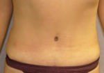 Tummy Tuck