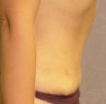 Tummy Tuck