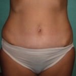 Tummy Tuck