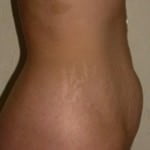 Tummy Tuck