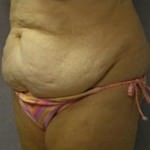 Tummy Tuck