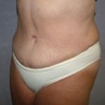 Tummy Tuck