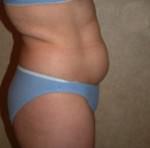 Tummy Tuck