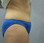 Tummy Tuck