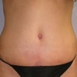 Tummy Tuck