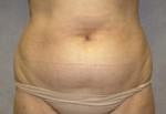 Tummy Tuck
