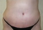 Tummy Tuck
