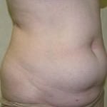 Tummy Tuck