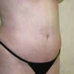 Tummy Tuck