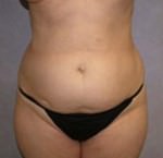 Tummy Tuck