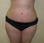 Tummy Tuck