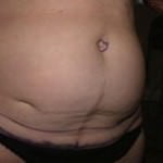 Tummy Tuck