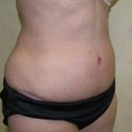Tummy Tuck