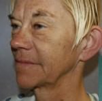Quick Facelift