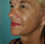 Quick Facelift