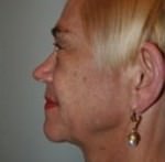 Quick Facelift