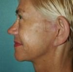 Quick Facelift