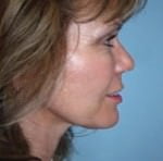 Quick Facelift