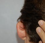 Ear Surgery
