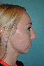Chin Augmentation