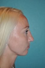 Chin Augmentation
