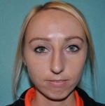 Chin Augmentation