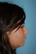 Chin Augmentation