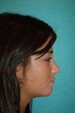 Chin Augmentation