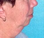 Chin Augmentation
