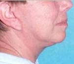 Chin Augmentation