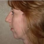 Chin Augmentation