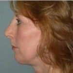 Chin Augmentation
