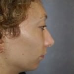 Chin Augmentation
