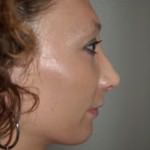 Chin Augmentation