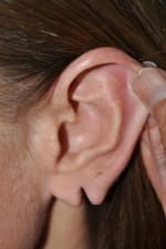 Earlobe Repair