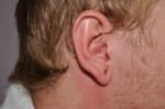Earlobe Repair