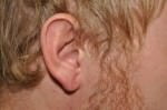 Earlobe Repair
