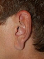 Earlobe Repair