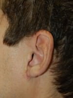 Earlobe Repair