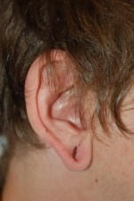 Earlobe Repair