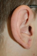 Earlobe Repair