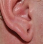 Earlobe Repair